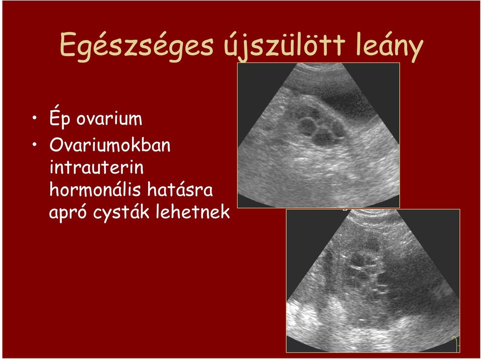 Ovariumokban intrauterin