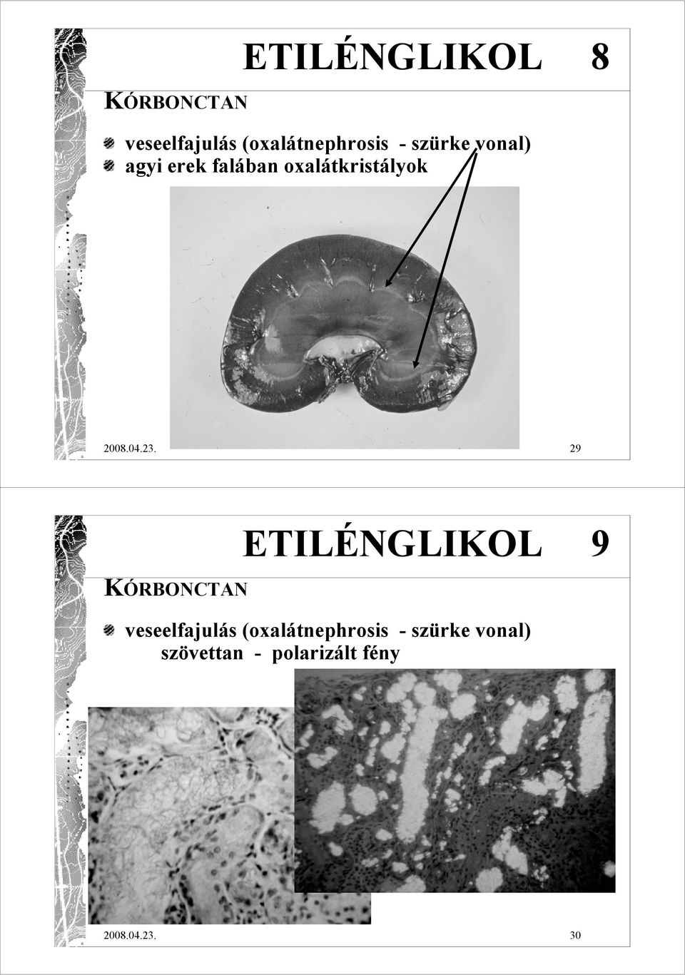 29 KÓRBONCTAN ETILÉNGLIKOL 9 veseelfajulás (oxalátnephrosis