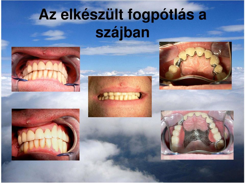 fogpótlás