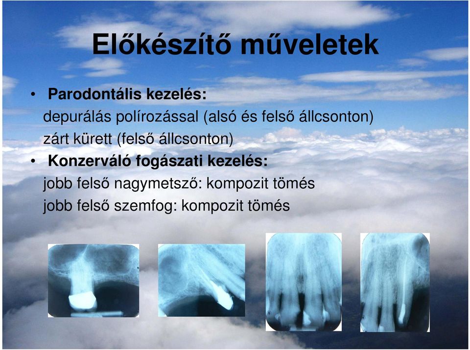 (felsı állcsonton) Konzerváló fogászati kezelés: jobb