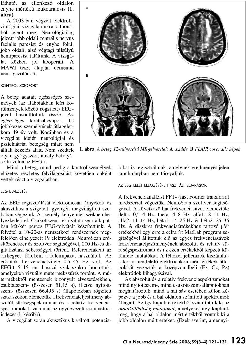 A MAWI teszt alapján dementia nem igazolódott. A KONTROLLCSOPORT A beteg adatait egészséges személyek (az alábbiakban leírt körülmények között rögzített) EEGjével hasonlítottuk össze.