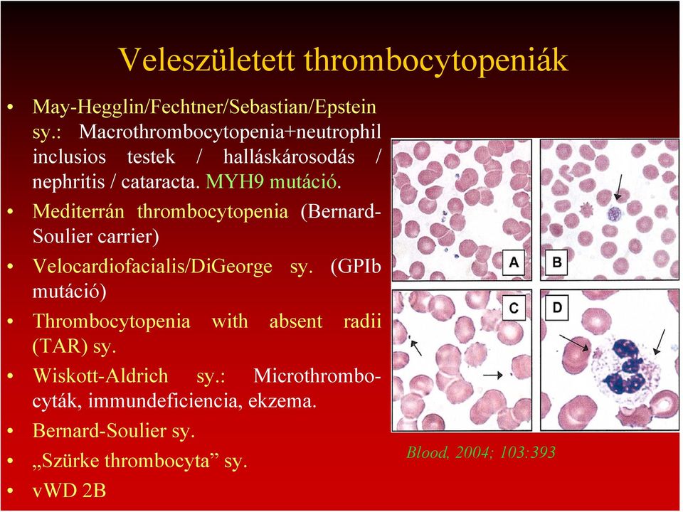 Mediterrán thrombocytopenia (Bernard- Soulier carrier) Velocardiofacialis/DiGeorge sy.