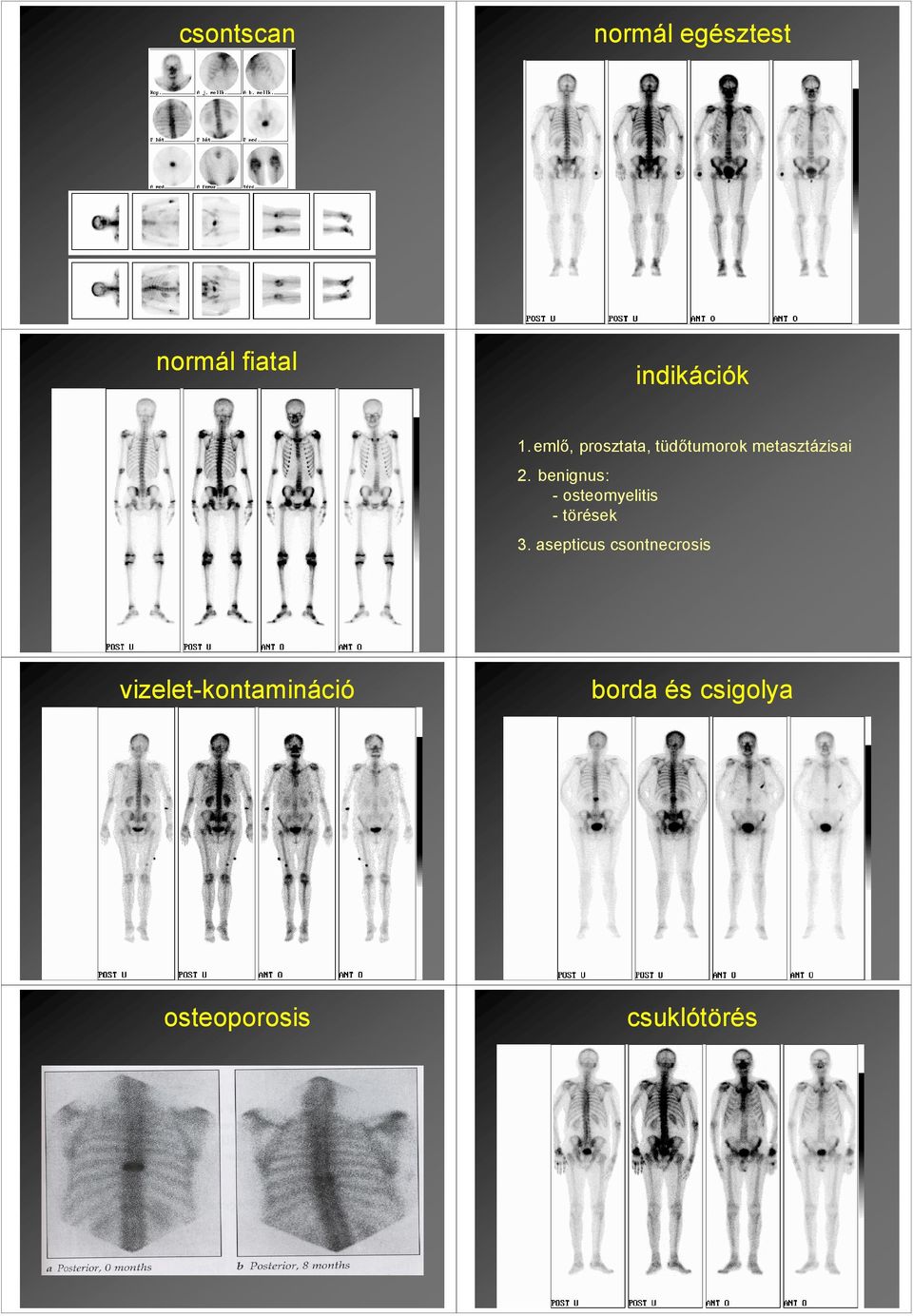 benignus: - osteomyelitis - törések 3.