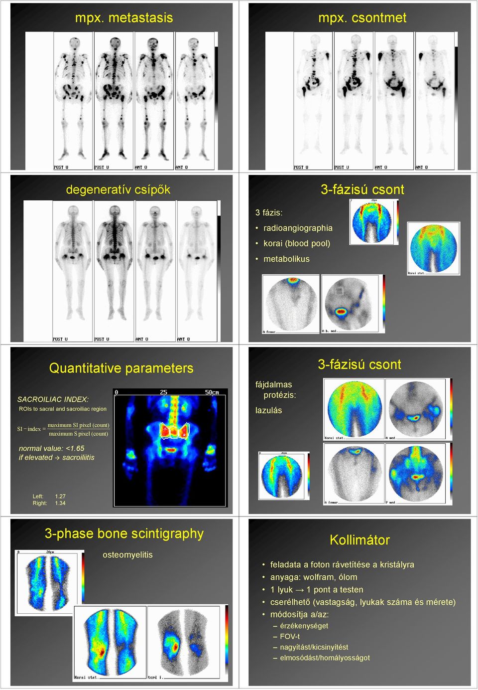 ROIs to sacral and sacroiliac region fájdalmas protézis: lazulás maximum SIpixel(count) SI index = maximum S pixel(count) normal value: <1.