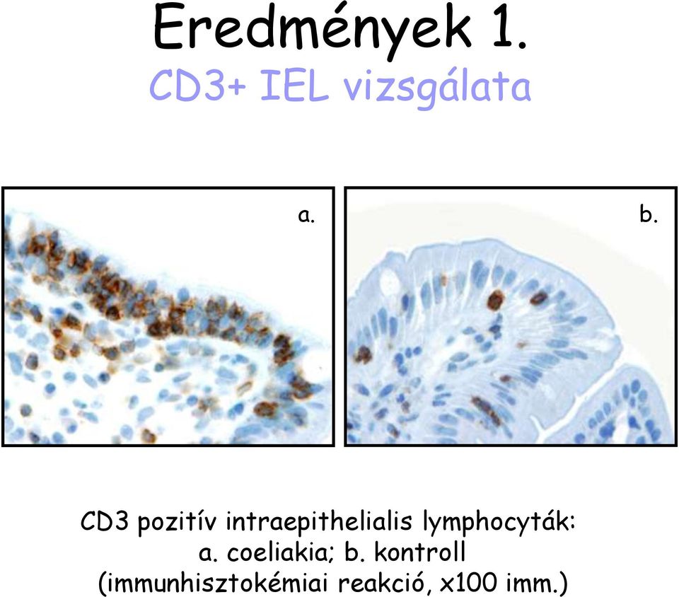 lymphocyták: a. coeliakia; b.