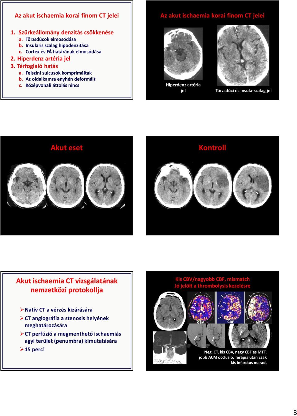 Középvonali áttolás nincs Hiperdenz artéria jel Törzsdúci és insula-szalag jel Akut eset Kontroll Akut ischaemia CT vizsgálatának nemzetközi protokollja Kis CBV/nagyobb CBF, mismatch Jó jelölt a