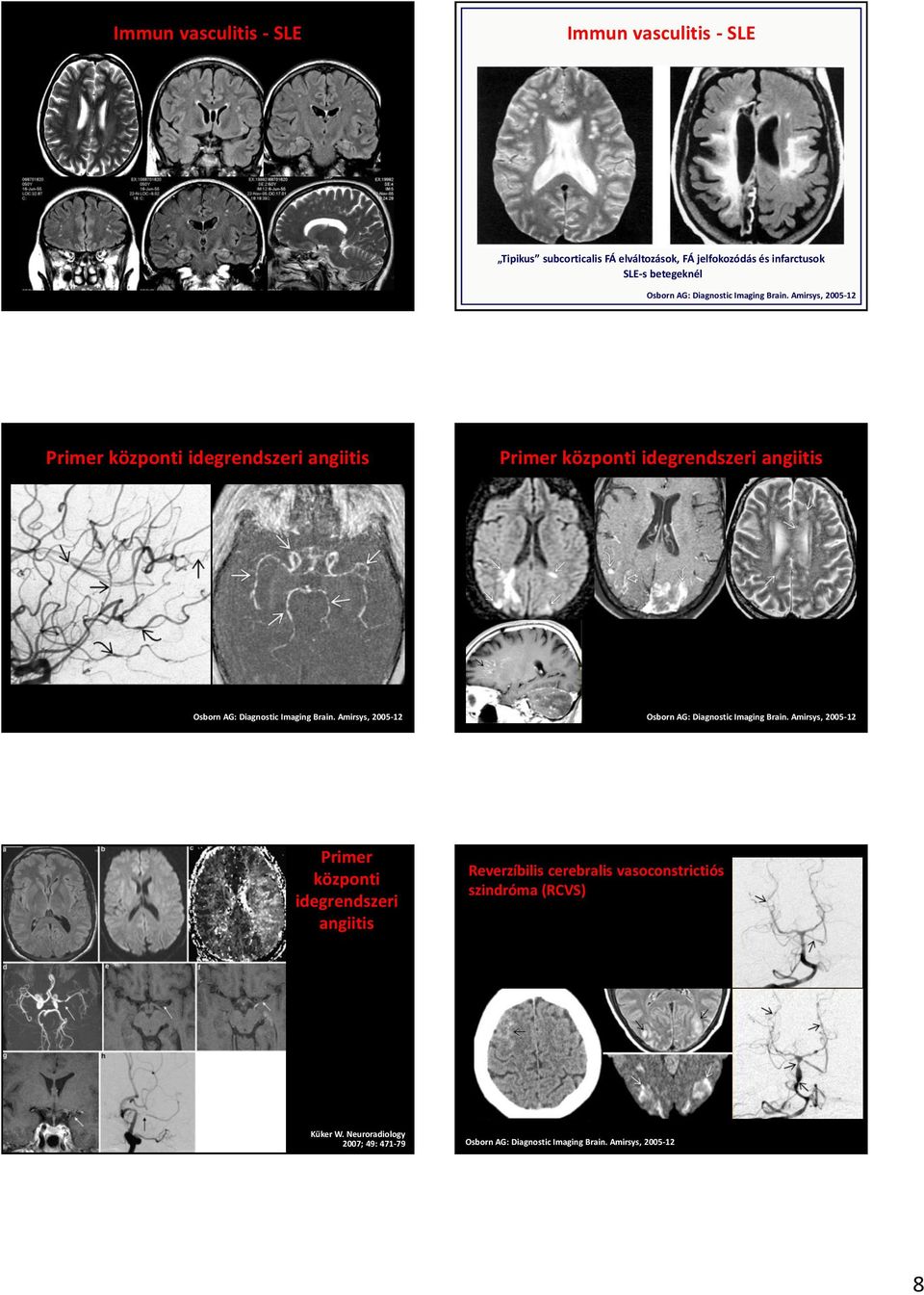 Amirsys, 2005-12 Primer központi idegrendszeri angiitis Primer központi idegrendszeri angiitis Osborn  Amirsys, 2005-12 Osborn  Amirsys,