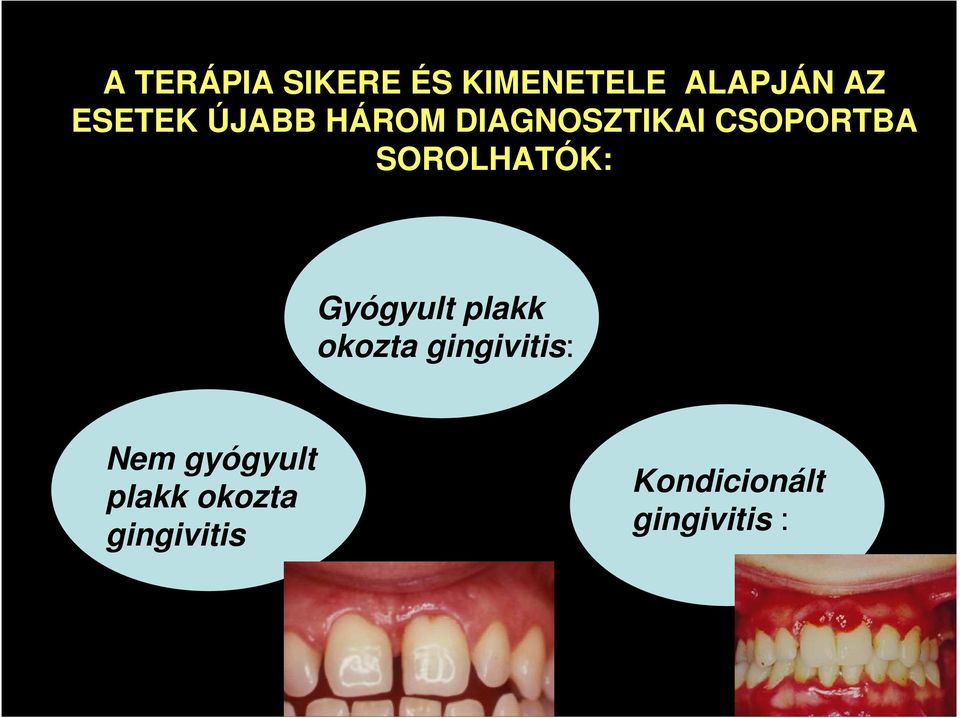 Gyógyult plakk okozta gingivitis: Nem gyógyult