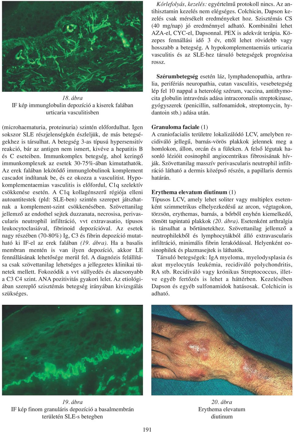 A hypokomplementaemiás urticaria vasculitis és az SLE-hez társuló betegségek prognózisa rossz. 18.