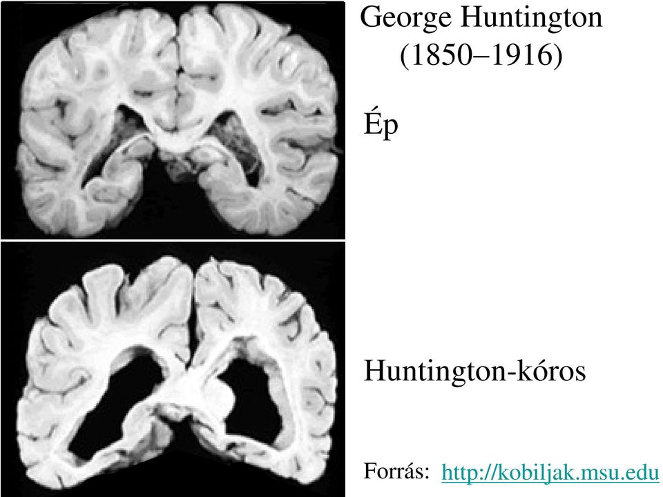 Huntington-kóros