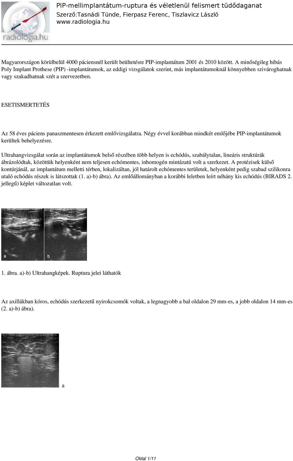 ESETISMERTETÉS Az 58 éves páciens panaszmentesen érkezett emlővizsgálatra. Négy évvel korábban mindkét emlőjébe PIP-implantátumok kerültek behelyezésre.