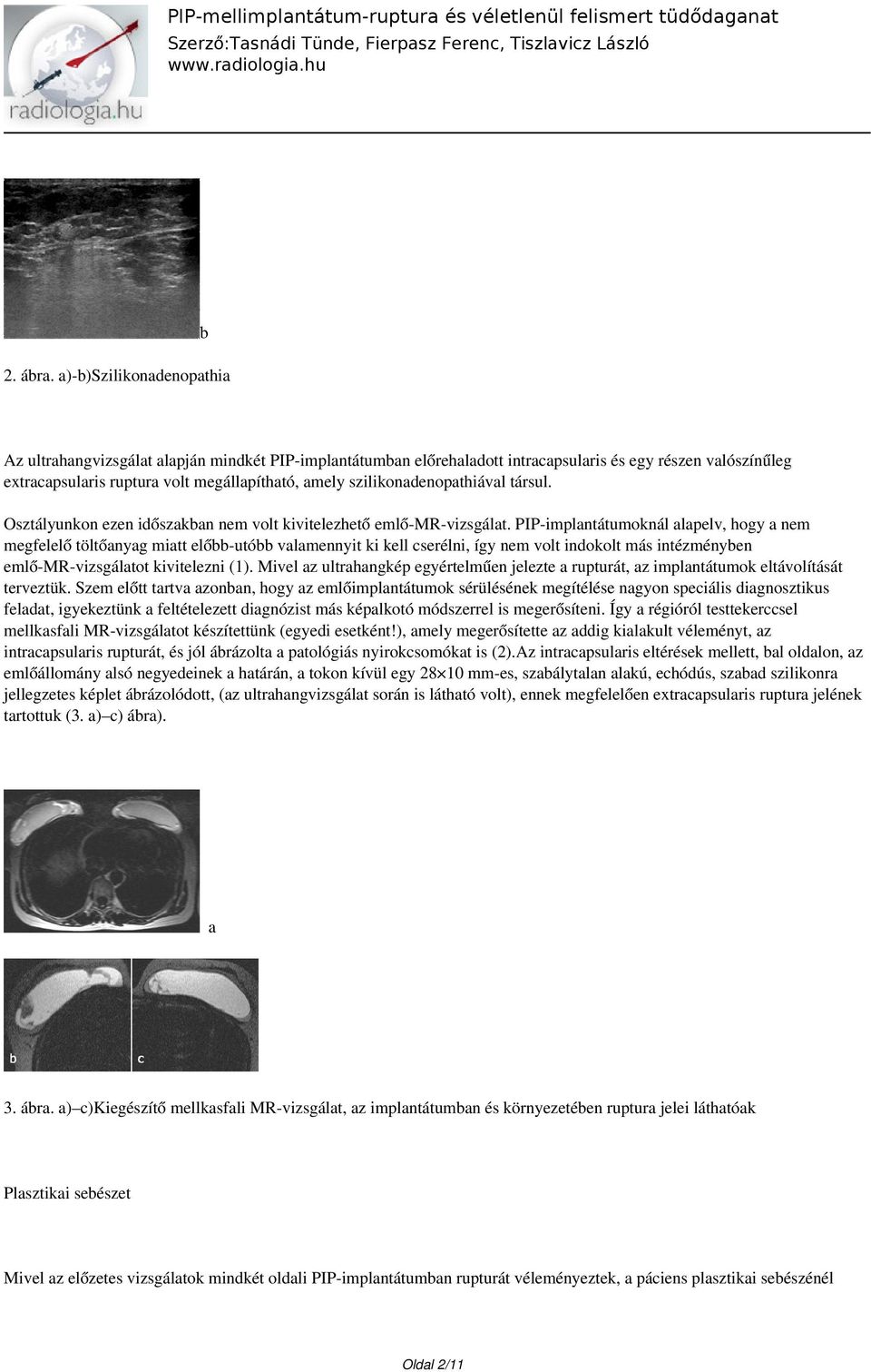 szilikonadenopathiával társul. Osztályunkon ezen időszakban nem volt kivitelezhető emlő-mr-vizsgálat.