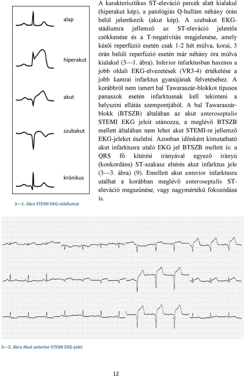 A szubakut EKGstádiumra jellemző az ST-eleváció jelentős csökkenése és a T-negativitás megjelenése, amely késői reperfúzió esetén csak 1-2 hét múlva, korai, 3 órán belüli reperfúzió esetén már néhány
