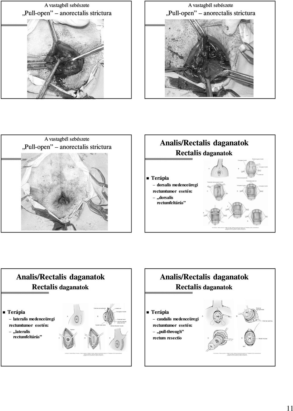 lateralis medenceüregi rectumtumor esetén: lateralis