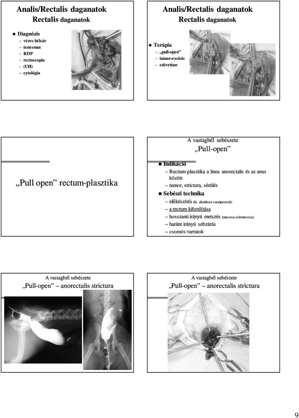 és az anus között tumor, strictura, sérülés Sebészi technika előkészítés (ld.