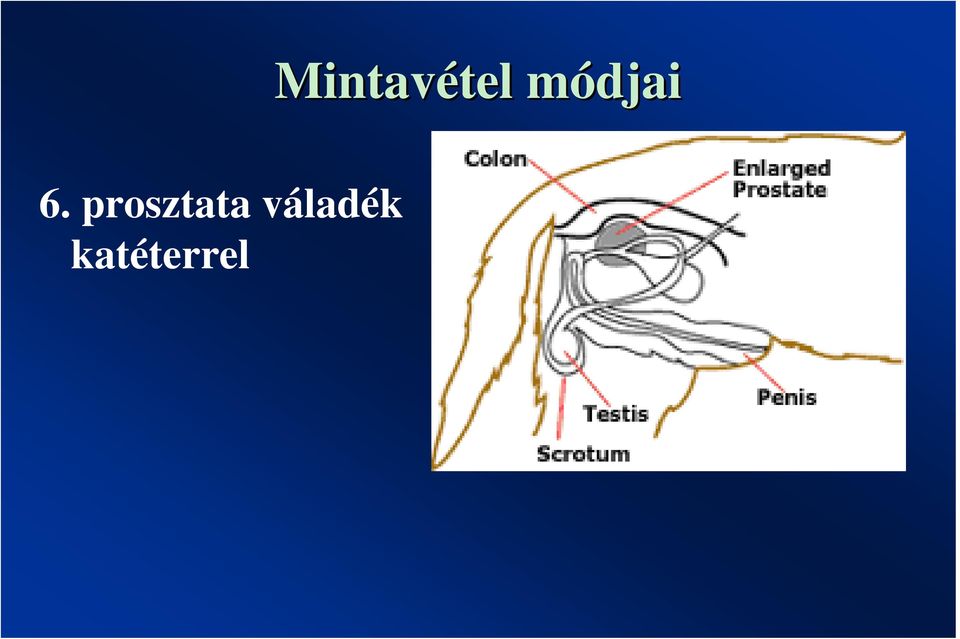 prosztata