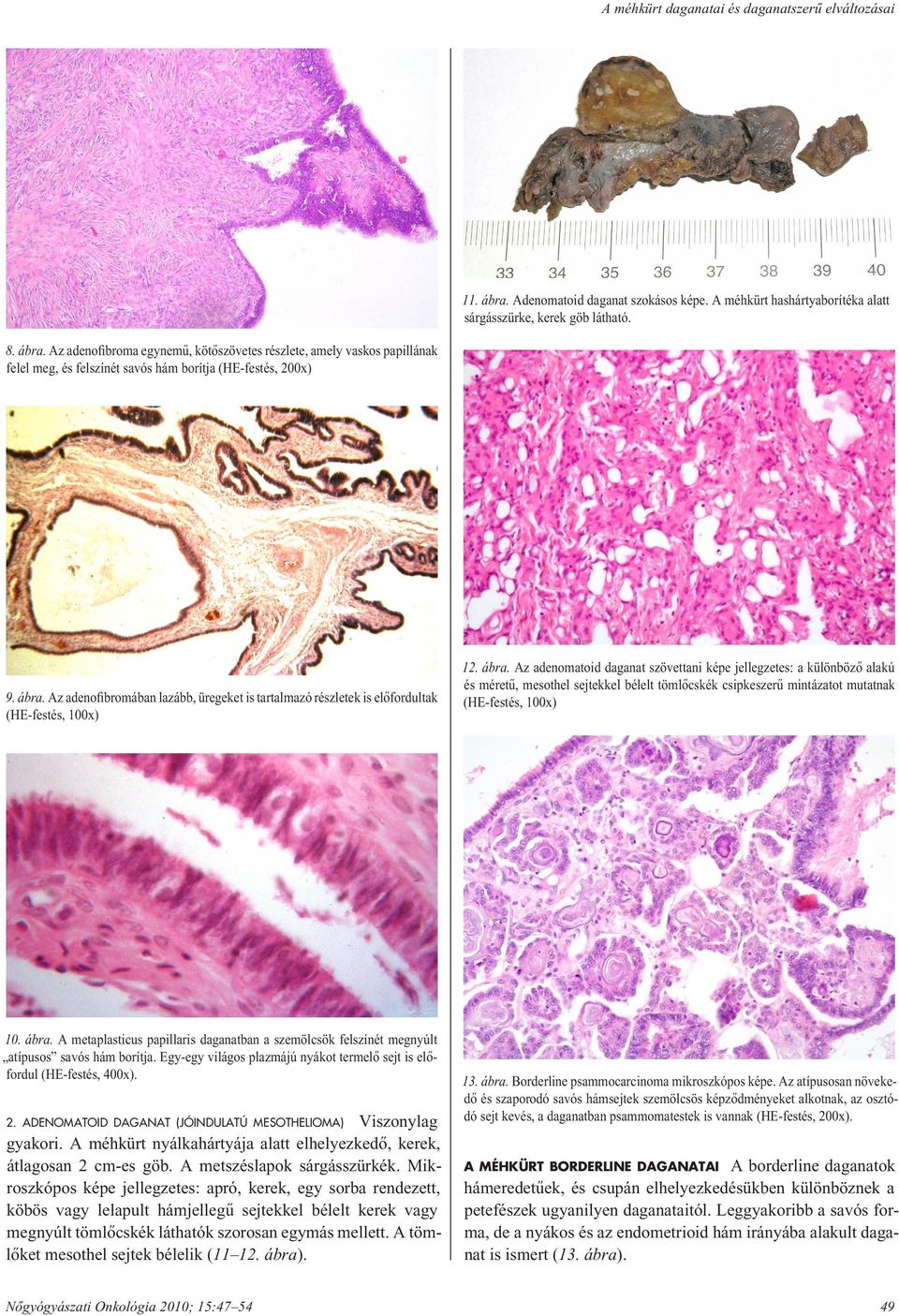 Az adenomatoid daganat szövettani képe jellegzetes: a különbözô alakú és méretû, mesothel sejtekkel bélelt tömlôcskék csipkeszerû mintázatot mutatnak (HE-festés, 100x) 10. ábra.