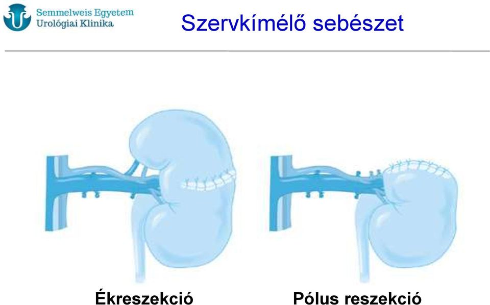 Ékreszekció