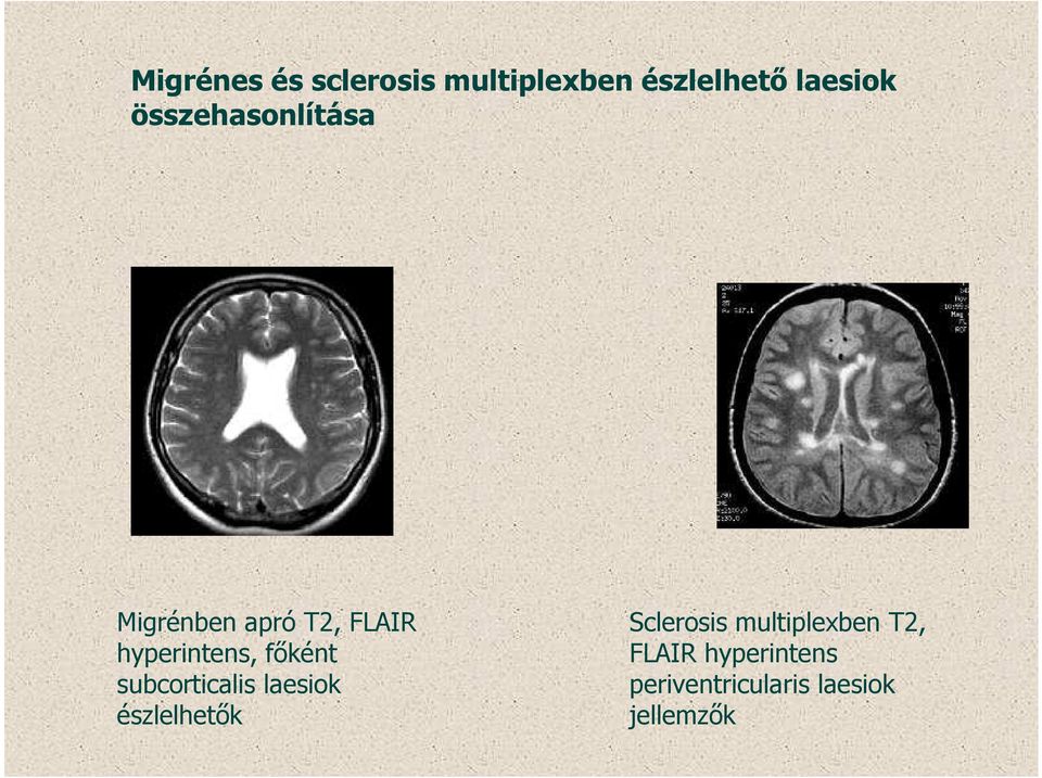 főként subcorticalis laesiok észlelhetők Sclerosis