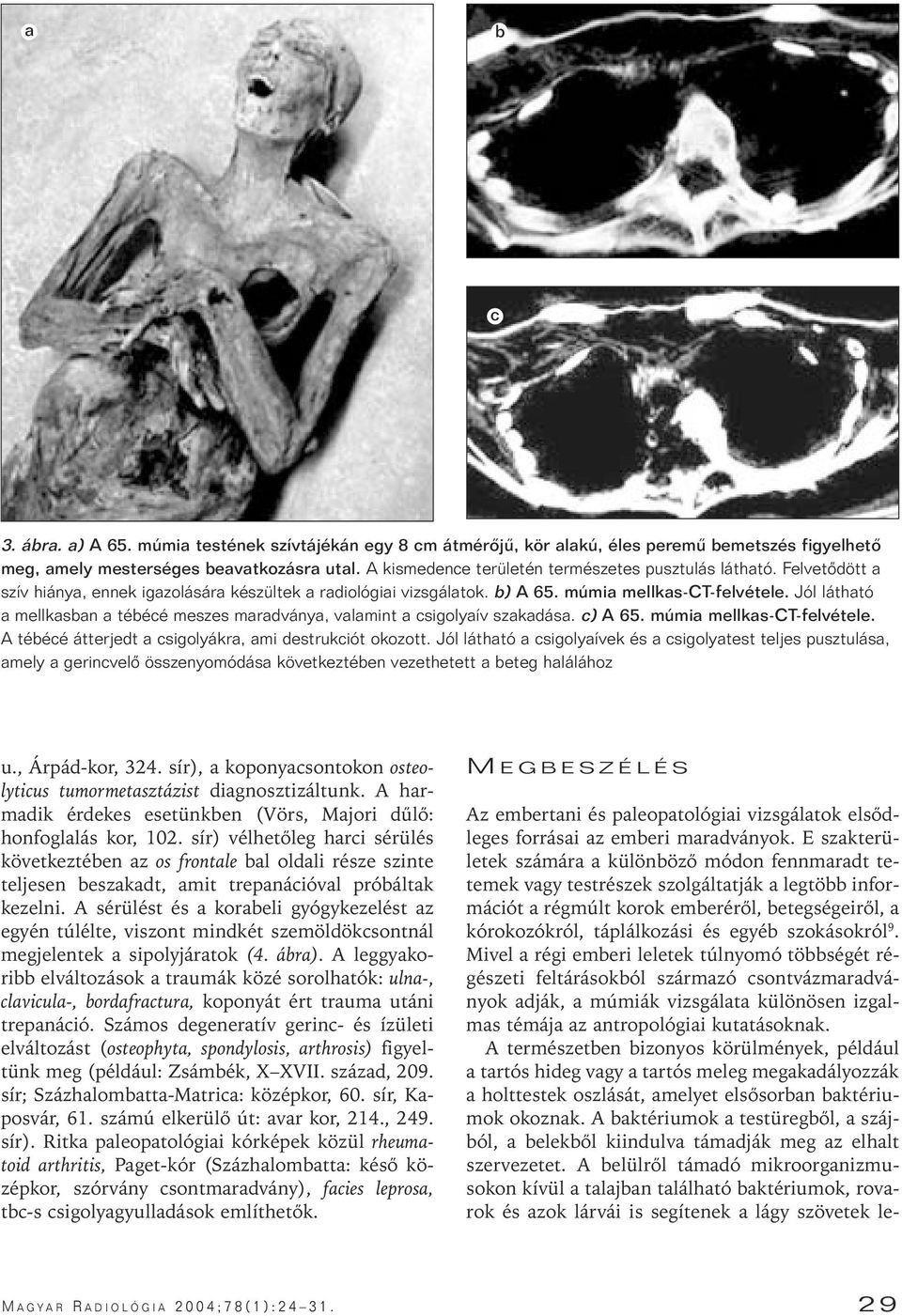 Jól látható a mellkasban a tébécé meszes maradványa, valamint a csigolyaív szakadása. c) A 65. múmia mellkas-ct-felvétele. A tébécé átterjedt a csigolyákra, ami destrukciót okozott.