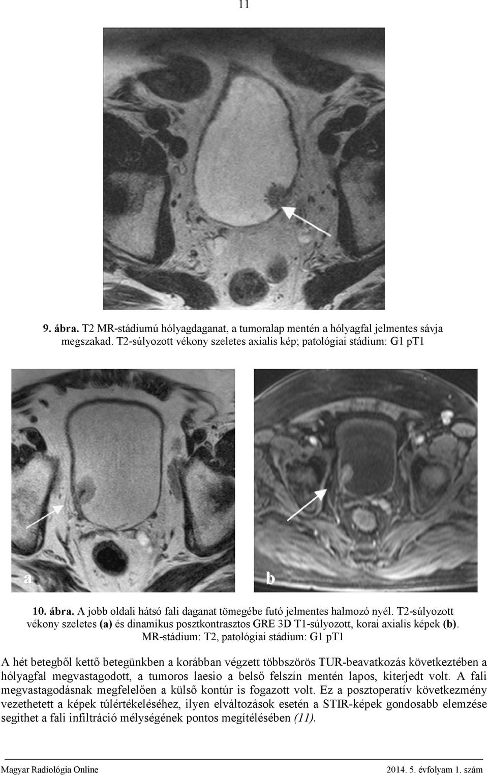MR-stádium: T2, patológiai stádium: G1 pt1 A hét betegből kettő betegünkben a korábban végzett többszörös TUR-beavatkozás következtében a hólyagfal megvastagodott, a tumoros laesio a belső felszín
