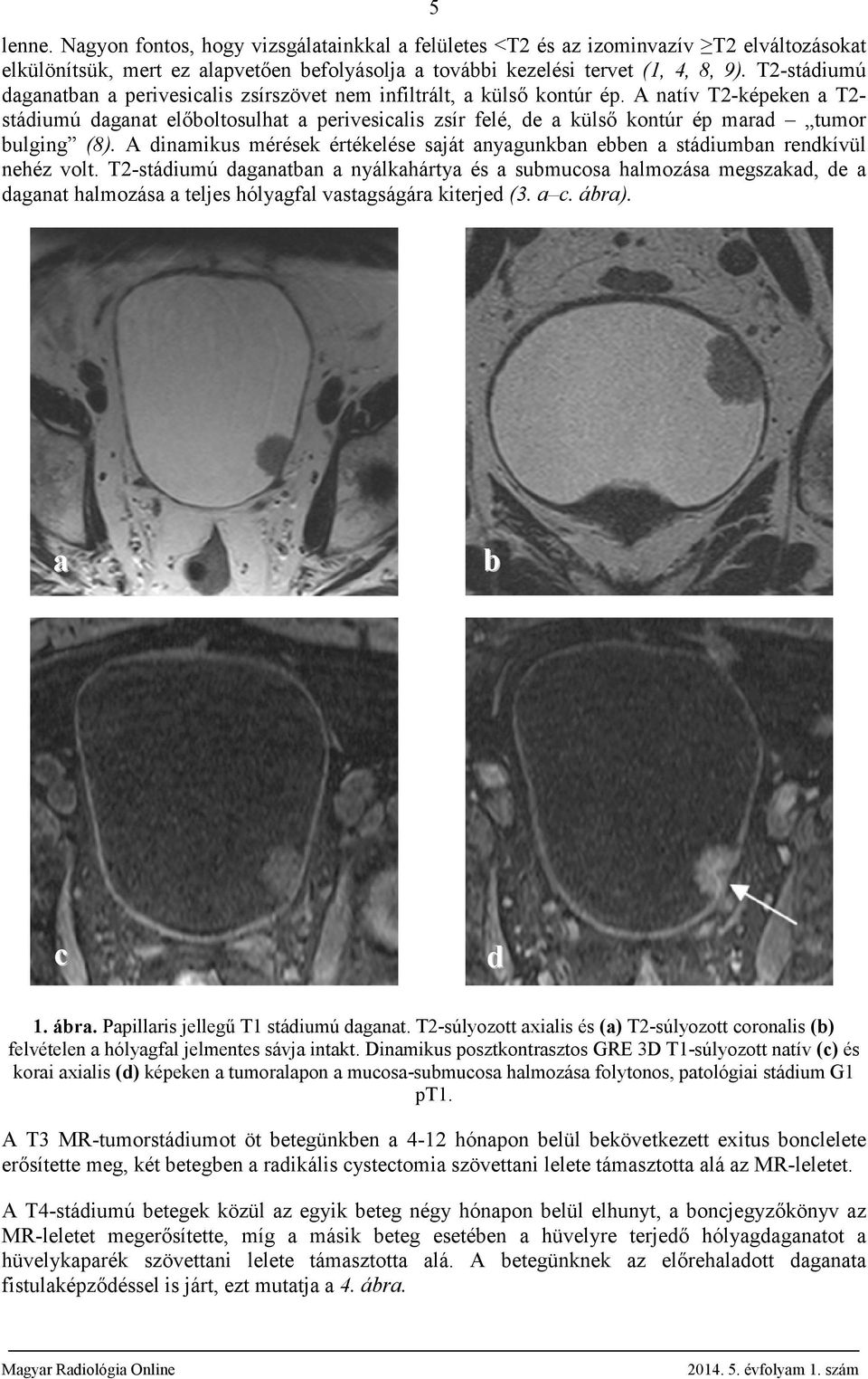 A natív T2-képeken a T2- stádiumú daganat előboltosulhat a perivesicalis zsír felé, de a külső kontúr ép marad tumor bulging (8).