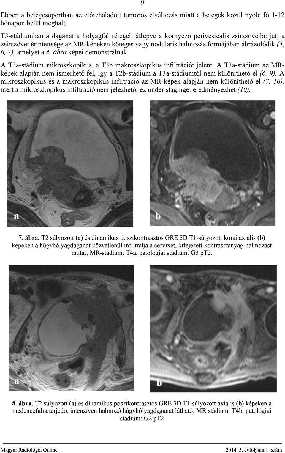 7), amelyet a 6. ábra képei demonstrálnak. A T3a-stádium mikroszkopikus, a T3b makroszkopikus infiltrációt jelent.