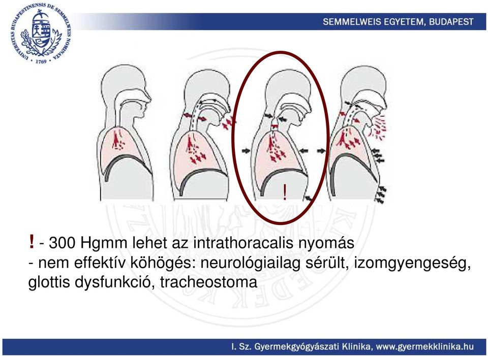 effektív köhögés: neurológiailag