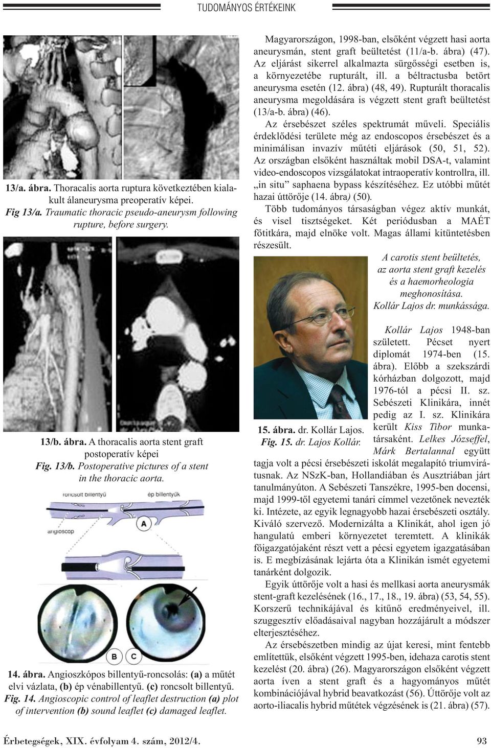 Angioszkópos billentyű-roncsolás: (a) a műtét elvi vázlata, (b) ép vénabillentyű. (c) roncsolt billentyű. Fig. 14.