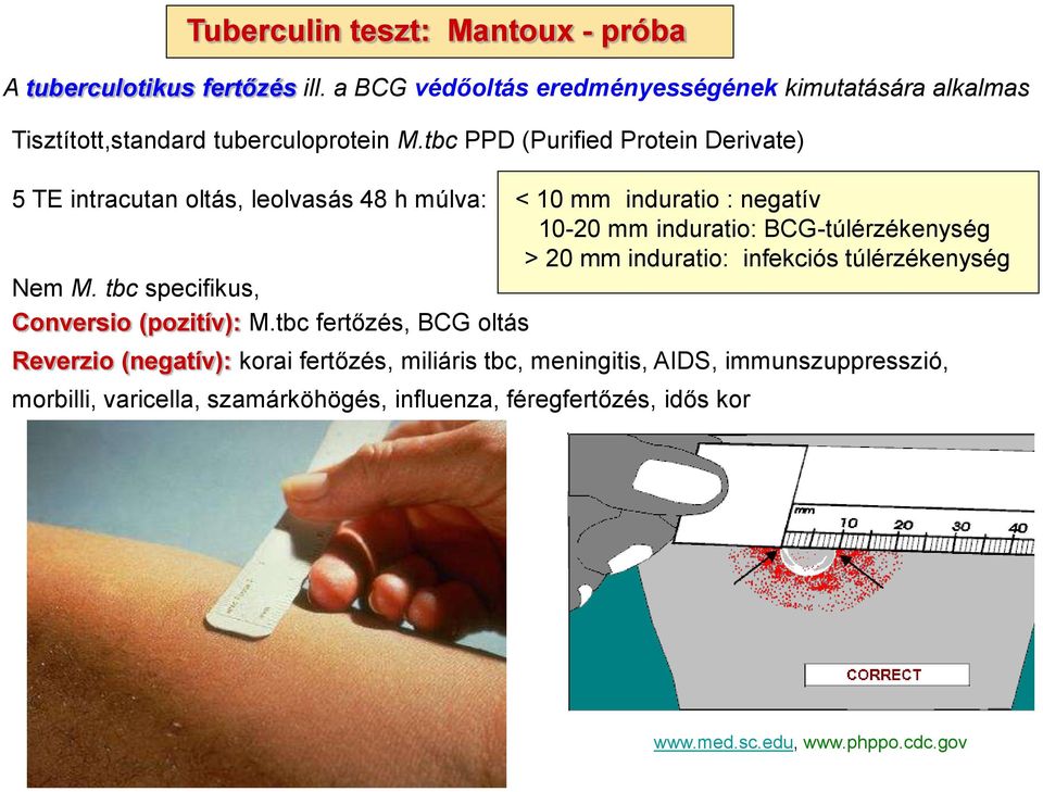 tbc PPD (Purified Protein Derivate) 5 TE intracutan oltás, leolvasás 48 h múlva: < 10 mm induratio : negatív 10-20 mm induratio: BCG-túlérzékenység > 20