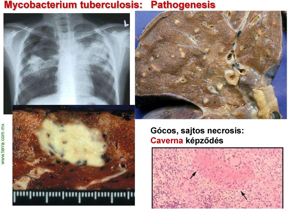 tuberculosis: