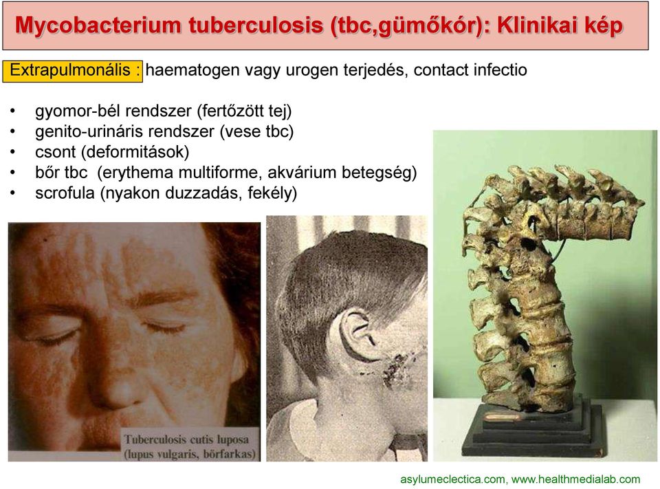genito-urináris rendszer (vese tbc) csont (deformitások) bőr tbc (erythema