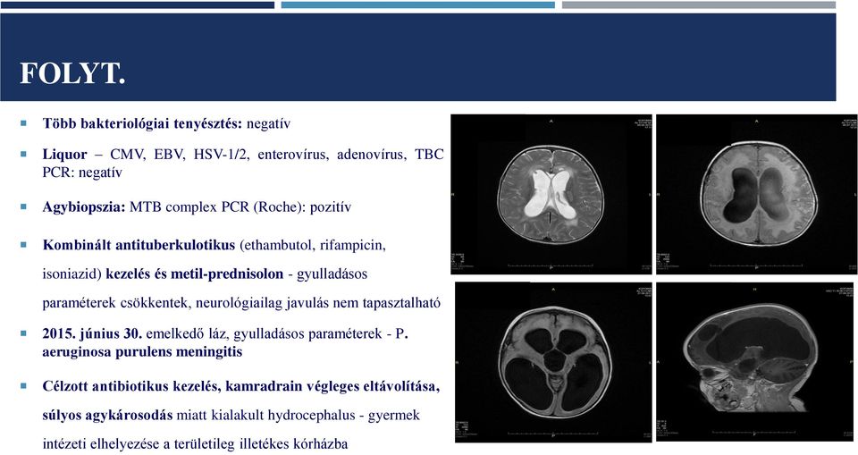 pozitív Kombinált antituberkulotikus (ethambutol, rifampicin, isoniazid) kezelés és metil-prednisolon - gyulladásos paraméterek csökkentek,