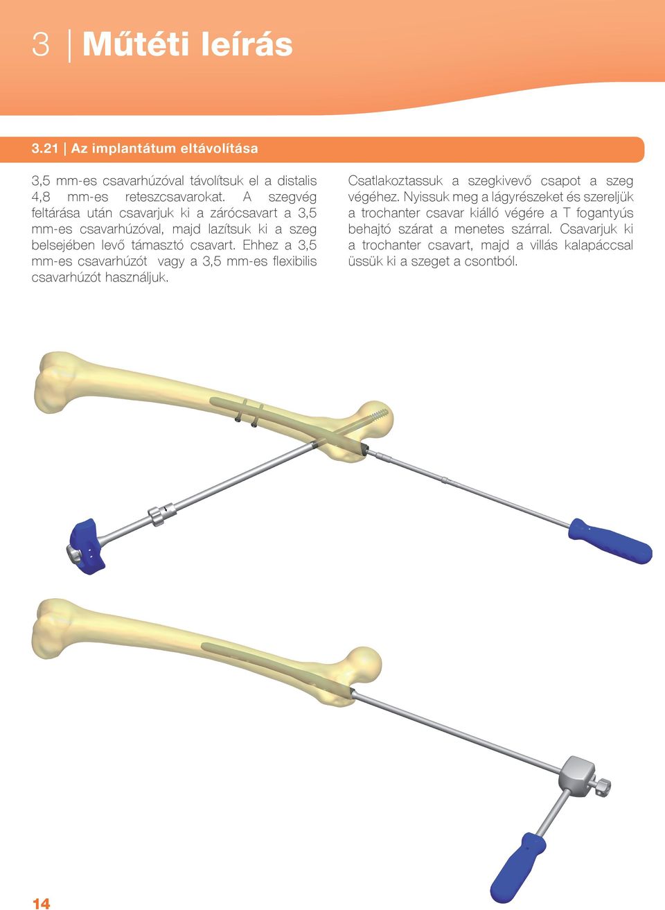 Ehhez a 3,5 mm-es csavarhúzót vagy a 3,5 mm-es flexibilis csavarhúzót használjuk. Csatlakoztassuk a szegkivevő csapot a szeg végéhez.