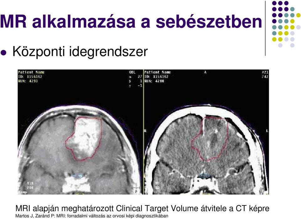 Target Volume átvitele a CT képre Martos J,