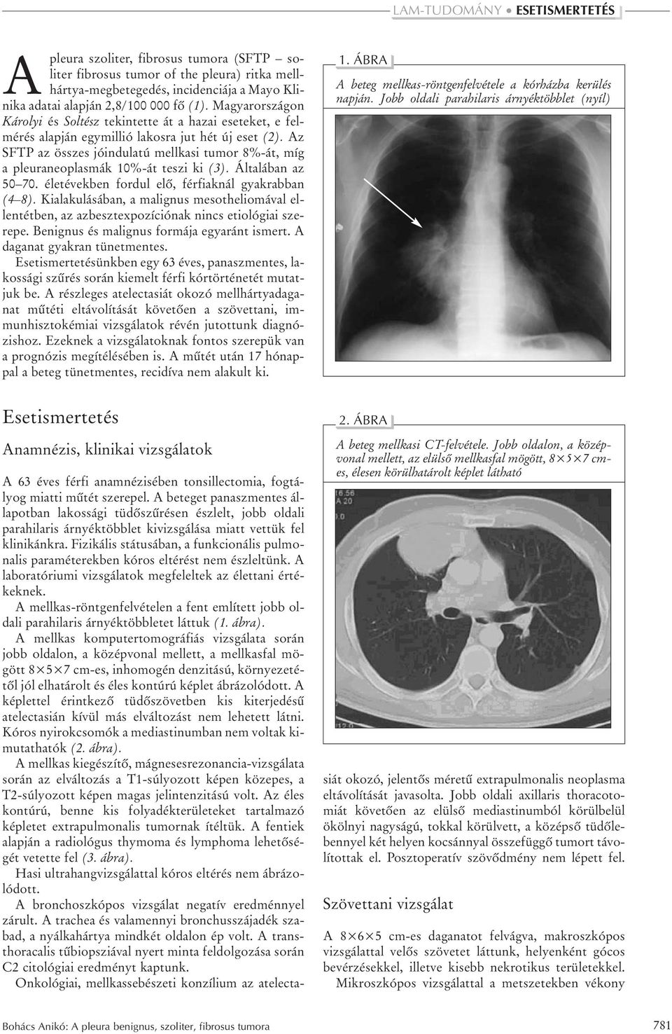 Az SFTP az összes jóindulatú mellkasi tumor 8%-át, míg a pleuraneoplasmák 10%-át teszi ki (3). Általában az 50 70. életévekben fordul elõ, férfiaknál gyakrabban (4 8).