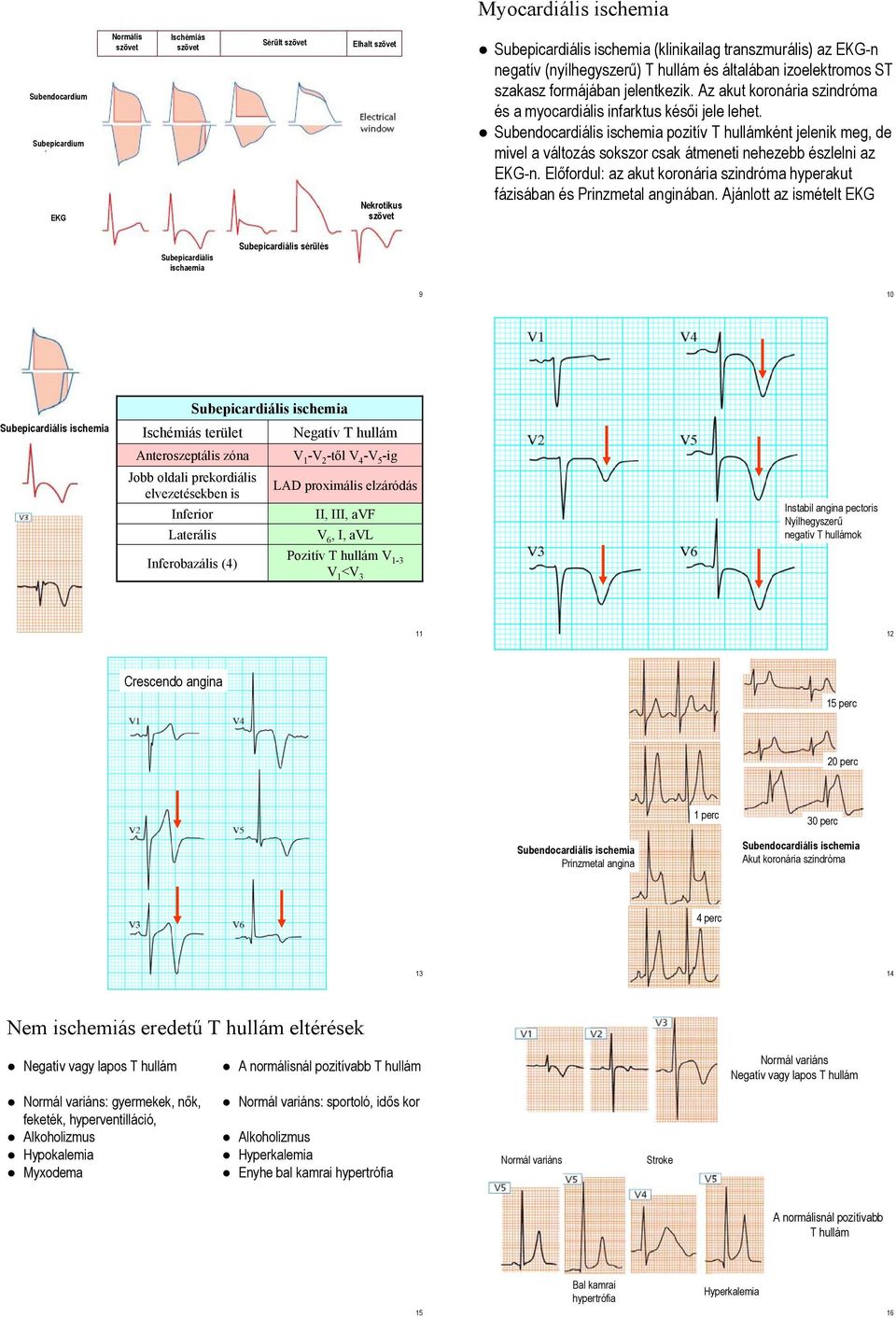 Subendocardiális ischemia pozitív T hullámként jelenik meg, de mivel a változás sokszor csak átmeneti nehezebb észlelni az EKG-n.