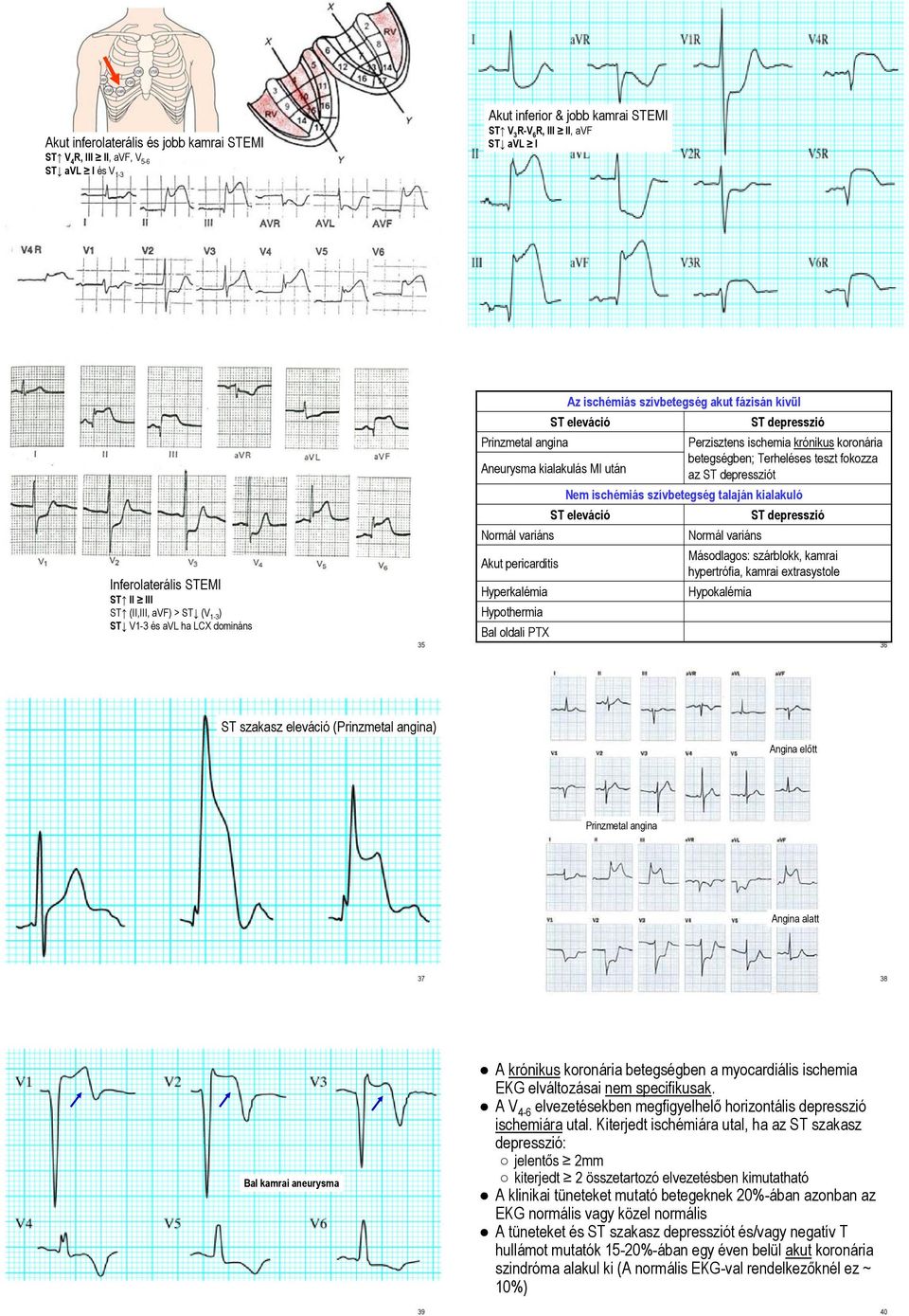szívbetegség akut fázisán kívül ST eleváció Perzisztens ischemia krónikus koronária betegségben; Terheléses teszt fokozza az t Nem ischémiás szívbetegség talaján kialakuló ST eleváció Normál variáns