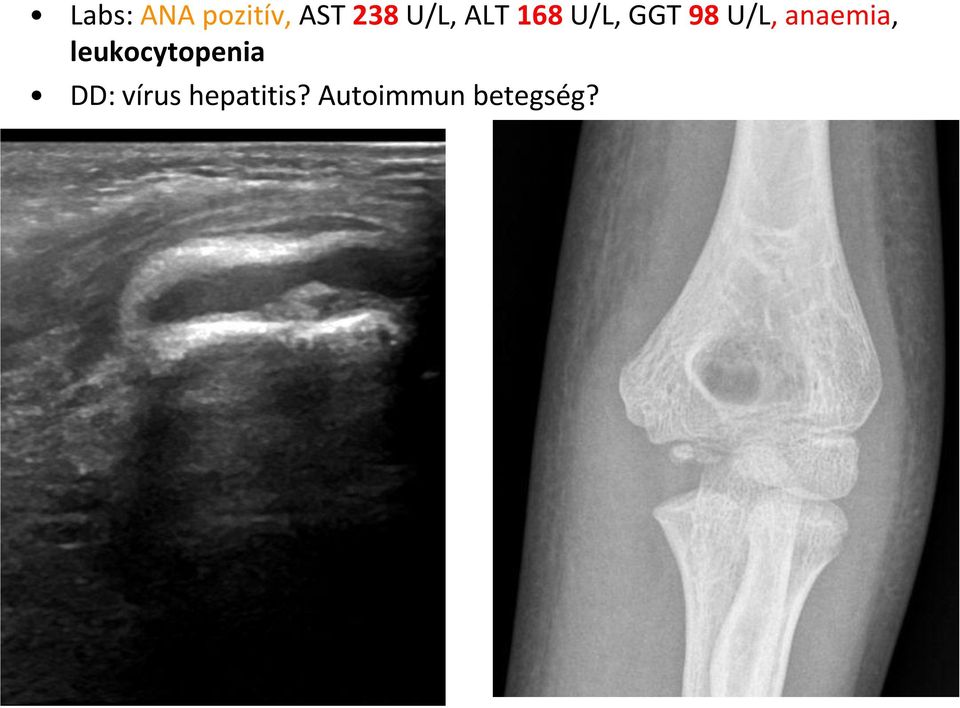 anaemia, leukocytopenia DD: