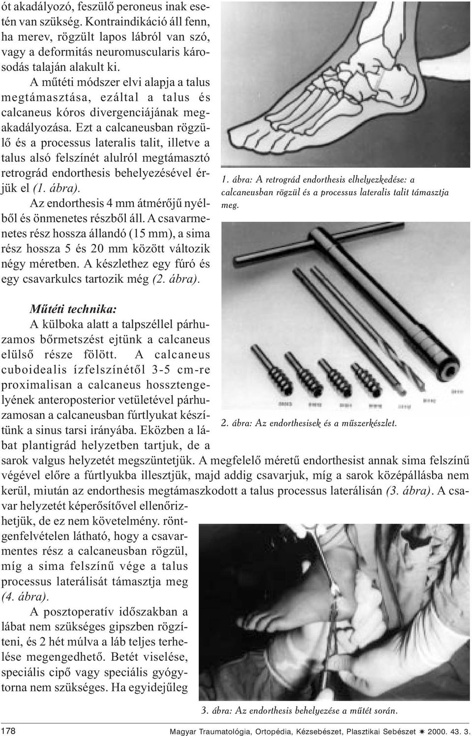 Ezt a calcaneusban rögzülõ és a processus lateralis talit, illetve a talus alsó felszínét alulról megtámasztó retrográd endorthesis behelyezésével érjük el (1. ábra).