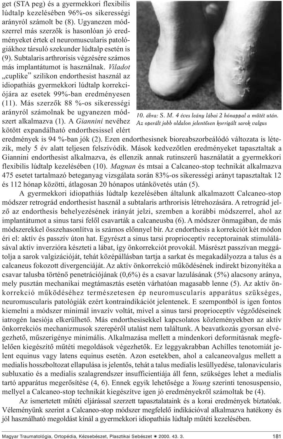 Subtalaris arthrorisis végzésére számos más implantátumot is használnak.