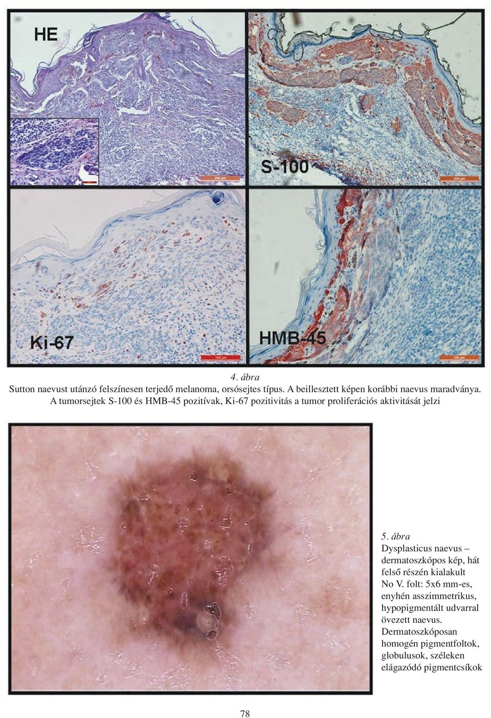 A tumorsejtek S-100 és HMB-45 pozitívak, Ki-67 pozitivitás a tumor proliferációs aktivitását jelzi 5.