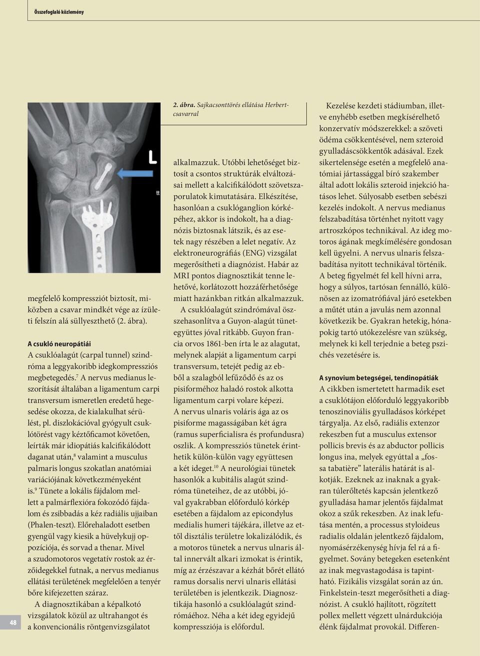 7 A nervus medianus leszorítását általában a ligamentum carpi transversum ismeretlen eredetű hegesedése okozza, de kialakulhat sérülést, pl.