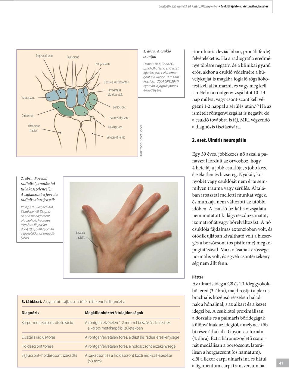 Diag nosis and management of scaphoid fractures (Am Fam Physician 2004;70[5]:880) nyomán, a jogtulajdonos engedélyével Fejescsont Foveola radialis Horgascsont Disztális kéztőcsontok Proximális