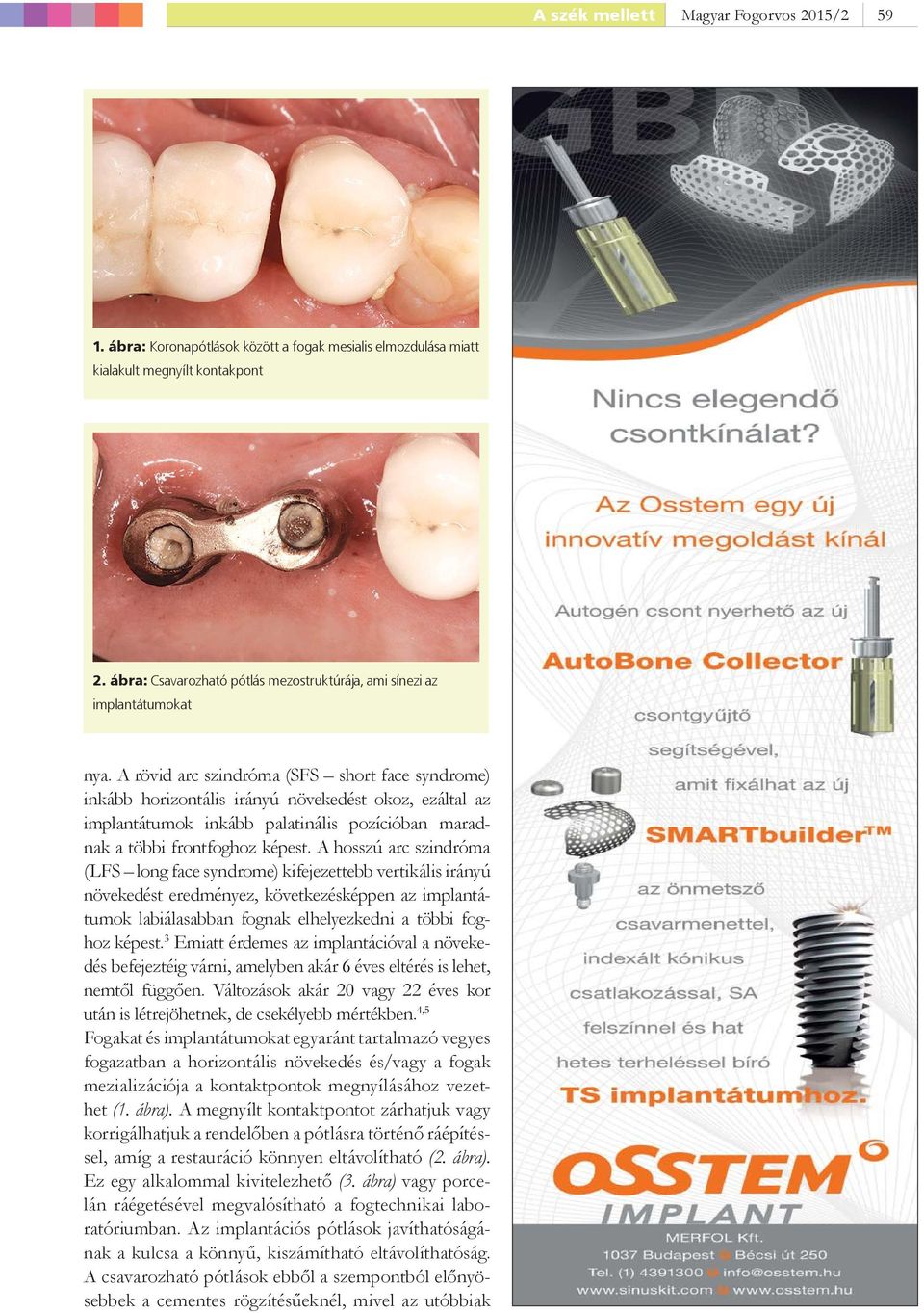A rövid arc szindróma (SFS short face syndrome) inkább horizontális irányú növekedést okoz, ezáltal az implantátumok inkább palatinális pozícióban maradnak a többi frontfoghoz képest.