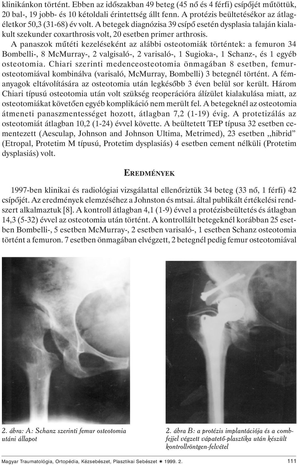 A panaszok mûtéti kezeléseként az alábbi osteotomiák történtek: a femuron 34 Bombelli-, 8 McMurray-, 2 valgisaló-, 2 varisaló-, 1 Sugioka-, 1 Schanz-, és 1 egyéb osteotomia.