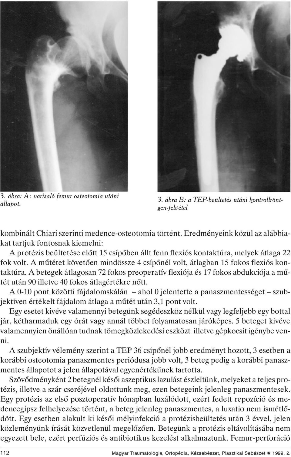 Csípôízületi totál endoprotézis-beültetés lehetôségei csípôkörüli  osteotomiát követôen - PDF Free Download