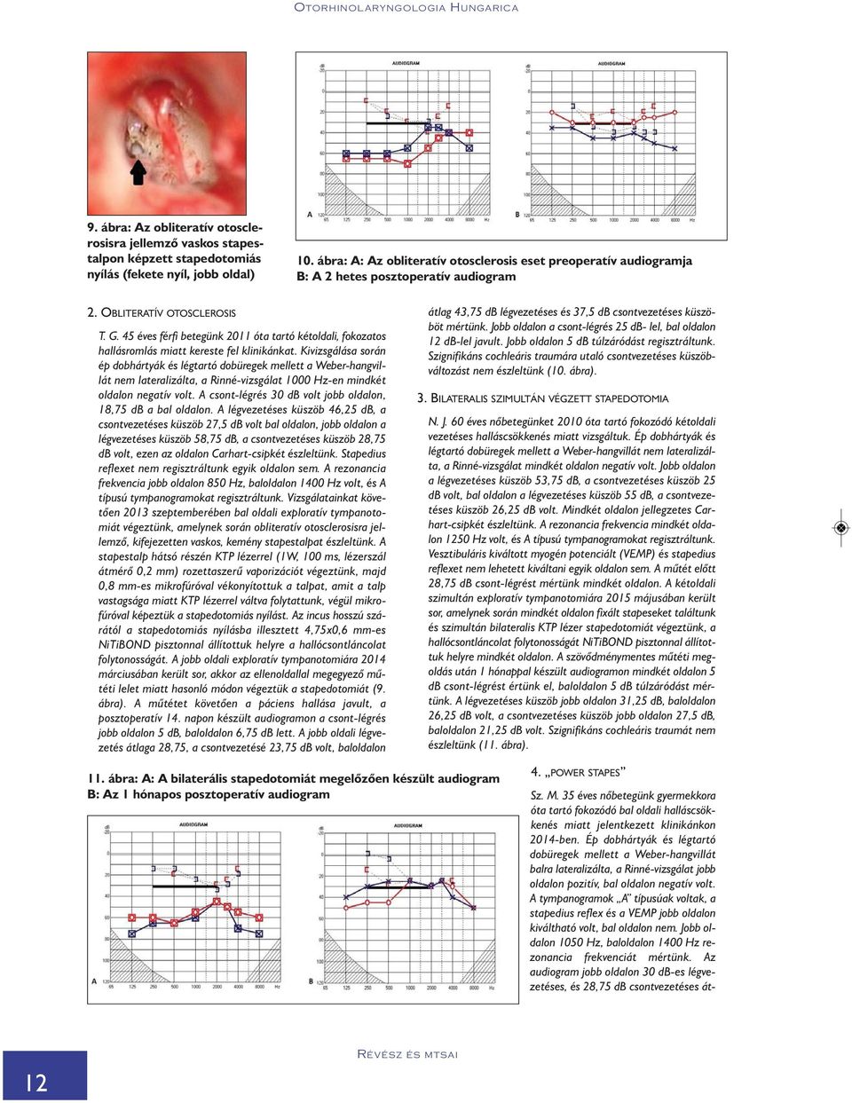 45 éves férfi betegünk 2011 óta tartó kétoldali, fokozatos hallásromlás miatt kereste fel klinikánkat.