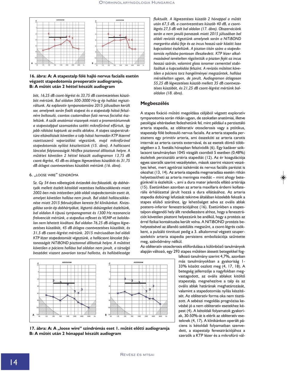 Az exploratív tympanotomiára 2015 júliusában került sor, amelynek során fixált stapest és a stapestalp hátsó felszínére boltosuló, csontos csatornában futó nervus facialist észleltünk.