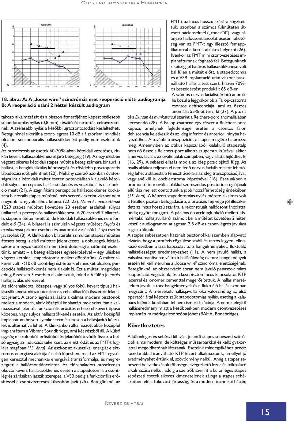 Betegünknél sikerült a csont-légrést 10 db alá szorítani mindkét oldalon, sensoneuralis halláscsökkenést pedig nem észleltünk (4).